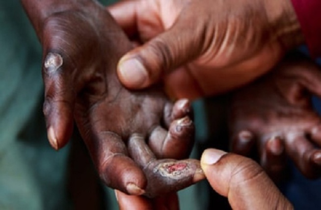 La lèpre toujours présente : Une dizaine de malades recensés à Diourbel La lèpre toujours présente : Une dizaine de malades recensés à Diourbel