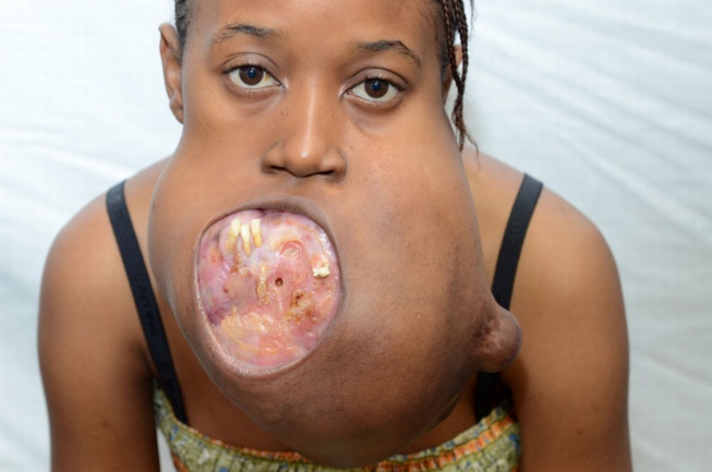 A 17 ans, elle a une tumeur de la taille d’un ballon de Football. Regardez