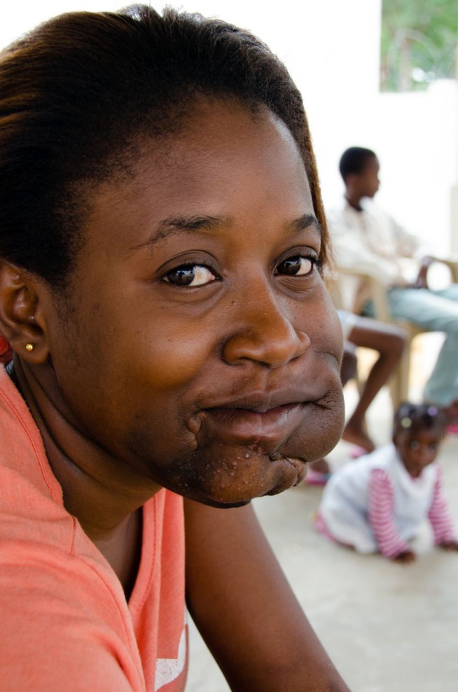 A 17 ans, elle a une tumeur de la taille d’un ballon de Football. Regardez A 17 ans, elle a une tumeur de la taille d’un ballon de Football. Regardez