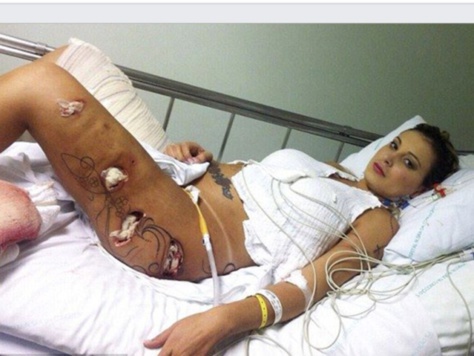 Elle a voulu gonfler ses fesses et ses jambes…Andressa entre la vie et la mort Elle a voulu gonfler ses fesses et ses jambes…Andressa entre la vie et la mort