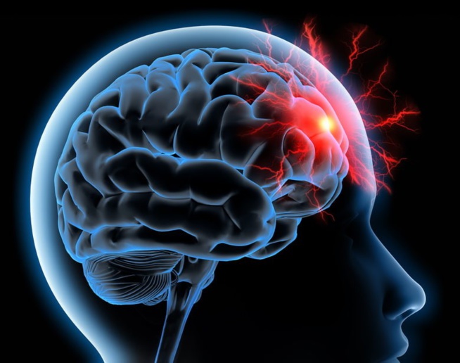 Prise En Charge De L’AVC : « Le Sénégal N’a Que De 5 Lits De Réanimation Neurologique » Prise En Charge De L’AVC : « Le Sénégal N’a Que De 5 Lits De Réanimation Neurologique »