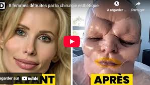 Chirurgie esthétique : 8 femmes victimes de dérives graves