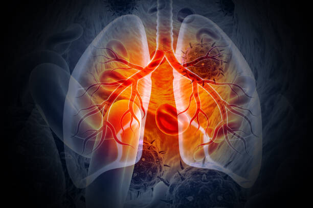 Ziguinchor : 420 cas de tuberculose en six mois, l’alerte est donnée