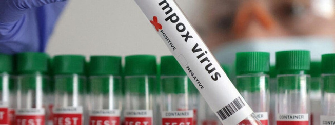 Mpox au Sénégal : Le seul patient recensé est totalement guéri, plus de cas actif de Mpox, vigilance maintenue par le ministère Mpox au Sénégal : Le seul patient recensé est totalement guéri, plus de cas actif de Mpox, vigilance maintenue par le ministère