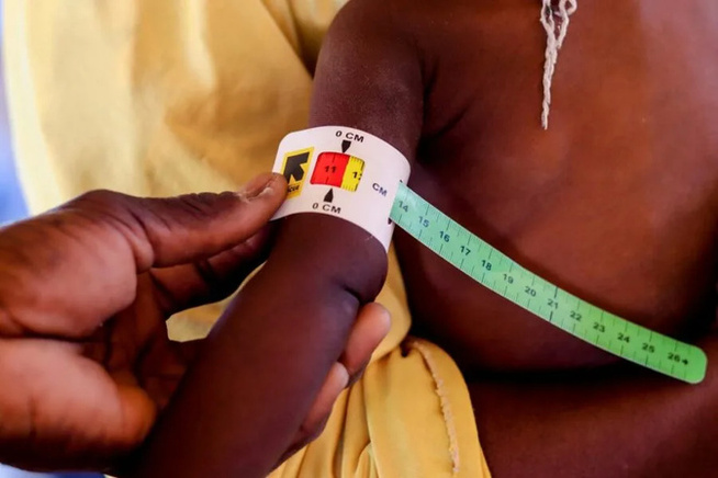 La malnutrition provoque une forme distincte de diabète, concluent des experts mondiaux La malnutrition provoque une forme distincte de diabète, concluent des experts mondiaux