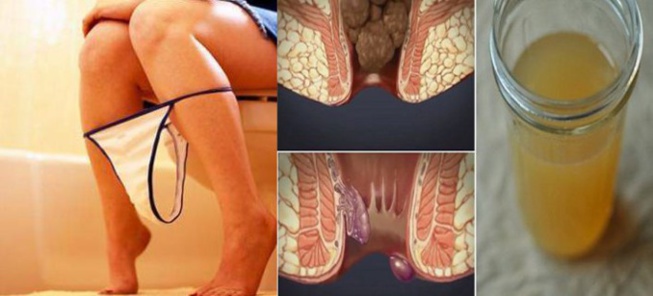 Guérissez vos hémorroïdes en 24 heures avec un seul ingrédient de votre cuisine ! Guérissez vos hémorroïdes en 24 heures avec un seul ingrédient de votre cuisine !