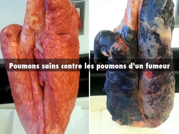 Attention danger: Les cigarettes light ont fait exploser le cancer du poumon