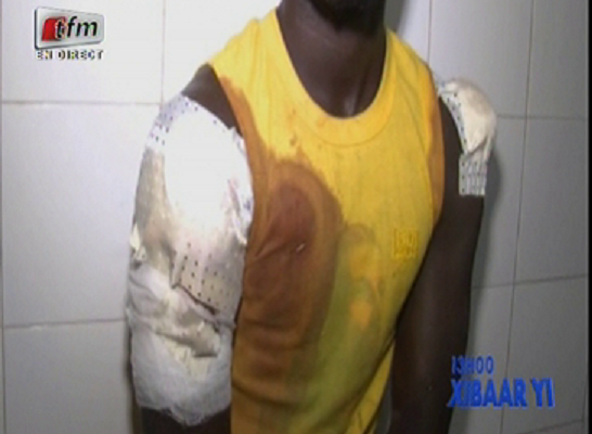 Chambre criminelle de Dakar: SA JAMBE AMPUTÉE, SA TÊTE FRACASSÉE… Comment le fils du présidentde l’Association des maures du Sénégal a été cruellement agressé