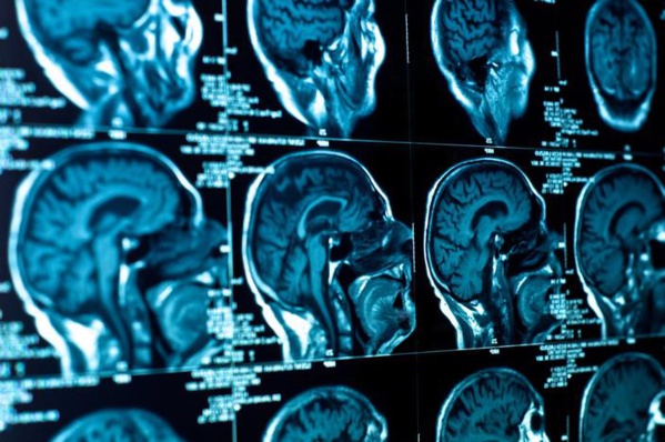Une intelligence artificielle se montre plus efficace que 15 médecins dans le diagnostic de tumeurs cérébrales