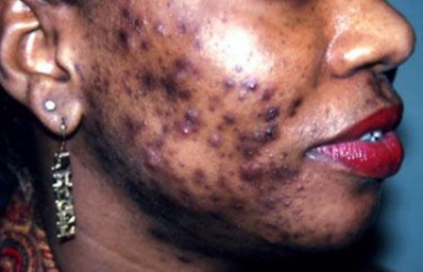 Publicité sur la dépigmentation : Les précisions du CNRA