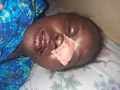 Guédiawaye: Ivre mort, un homme défigure le visage de sa femme (photo)