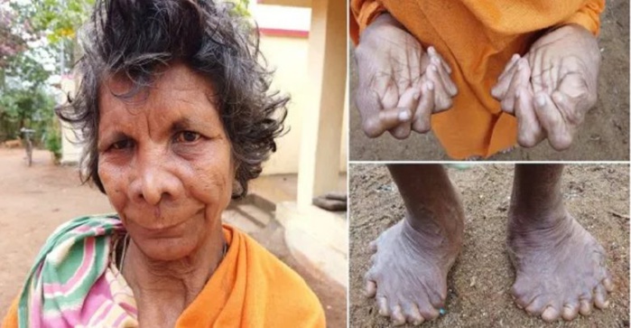 Inde: Découverte d’une femme avec 31 doigts et orteils