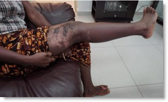 Louga: Bagarre entre coépouses, Rouguiyatou Sow casse le bras d’Absa Sow