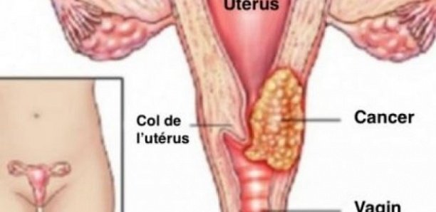 Cancer du col de l'utérus : 80 % de 2 500 cas meurent par an