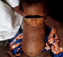 Au Togo, une fillette naît sans bras
