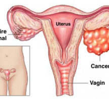 Vous doublez votre risque de cancer des ovaires en faisant ceci