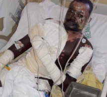 Sa femme lui verse de l'huile chaude et s'enfuit, Babacar Mbaye entre la vie et la mort (images)