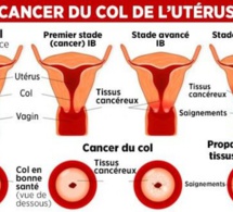 Cancer du col de l’utérus : « Chaque année, le Sénégal enregistre 875 cas », selon la Lisca