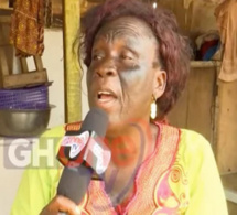 Ghana: Elle perd la vue dans ses tentatives de se blanchir la peau