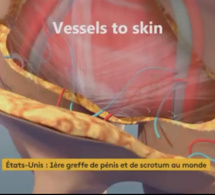 La première greffe de pénis et de scrotum au monde réalisée aux Etats-Unis