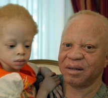 Djéneba Diarra Une jeune albinos assassinée et son corps décapité à l’approche des élections