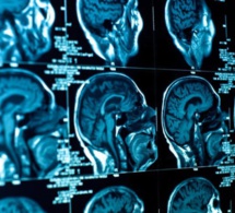 Une intelligence artificielle se montre plus efficace que 15 médecins dans le diagnostic de tumeurs cérébrales