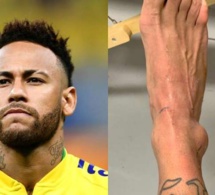 ( Photos ) Brésil : Neymar publie une photo de sa cheville après sa blessure