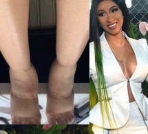 Cardi B: ses pieds et son ventre « très enflés » après des chirurgies esthétiques (photo)