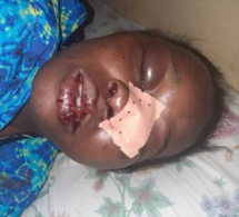 Guédiawaye: Ivre mort, un homme défigure le visage de sa femme (photo)