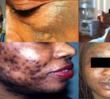 Dépigmentation: Au-delà d’une simple interdiction de la publicité