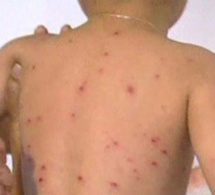 Épidémie de rougeole à Vélingara : 26 cas déjà détectés