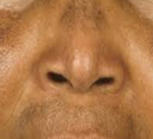 Dépigmentation : Des hommes sont entrés dans la danse