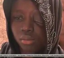 La douloureuse histoire d’une jeune fille qui a perdu un œil