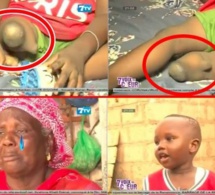 Rufisque : Triste histoire de Bébé Mouhamed (3ans) né avec une seule jambe