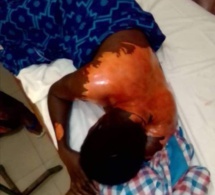 Darou Mouhty: Ebouillantée par sa coépouse A. N., le chantage répugnant d'un mari