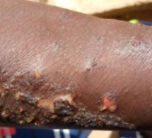 Maladie mystérieuse: les femmes de Ndayane ont trouvé le "vaccin", en deux jours, on...