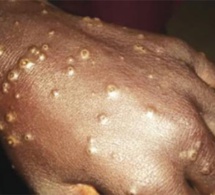 Maladie mystérieuse: 507 cas déclarés entre Ndayane, Joal et Mbour