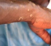 Maladie des pêcheurs : « Une contamination chimique ponctuelle, pas un effet viral ou dû aux algues» Brahima Cissé, de Greenpeace Afrique