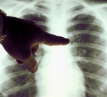 Santé-Elimination de la tuberculose en 2035 : l’Etat mise sur la prise en charge des cas contagieux