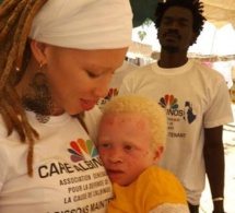 Le groupe Takeifa soutient les Albinos