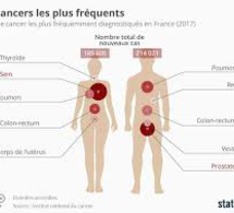 Les types de cancer les plus courants chez les hommes et les femmes listés par un médecin