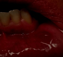 L’amant mord sa copine et lui arrache une partie de la lèvre inférieure : Il prétend avoir vu un monstre