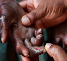 La lèpre au Sénégal: Près de 200 nouveaux cas recensés en 2020