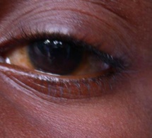 Covid-19 et épidémie de conjonctivite: Les éclairages du Pr. Pape Ndiaye, ophtalmologue