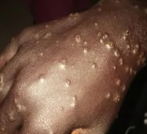 Maladie de la peau, un nouveau cas détecté à Thiaroye-sur-mer: Vers une deuxième vague ?