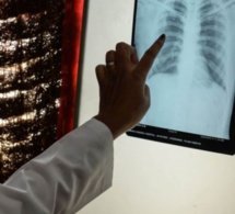 Tuberculose: Diourbel est la deuxième région la plus touchée du Sénégal