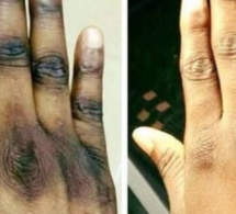 Dangers liés à la dépigmentation et au tabac : Des experts de la santé préconisent la réduction du coût des produits alternatifs