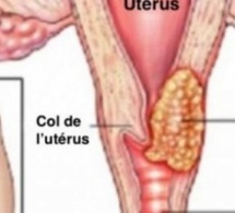 Cancer du col de l'utérus : 80 % de 2 500 cas meurent par an