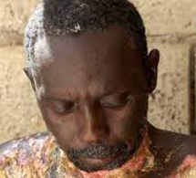 Guédiawaye / Grièvement brûlé, Babacar se meurt à petit feu (Ames sensibles s'abstenir)