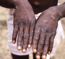 Variole du singe : l’Afrique doit miser sur le dépistage (OMS)